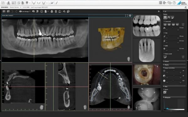 Røntgenbilleder fra Vistasoft røntgenprogram fra Dürr