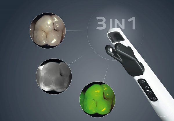 KaVo DIAGNOcam Vision Full HD 3-i-1-illustration med tre røntgenbilleder af samme tand, men forskelligt filter