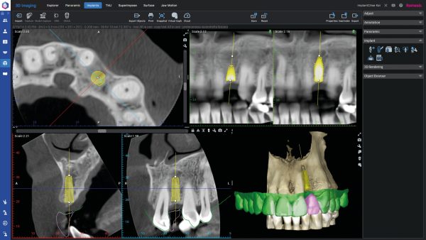 Planmeca Romexis røntgensoftware interface ved implantater